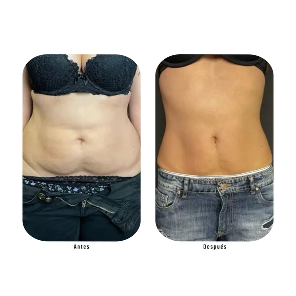 Resultado real Plan Zero Celulitis
