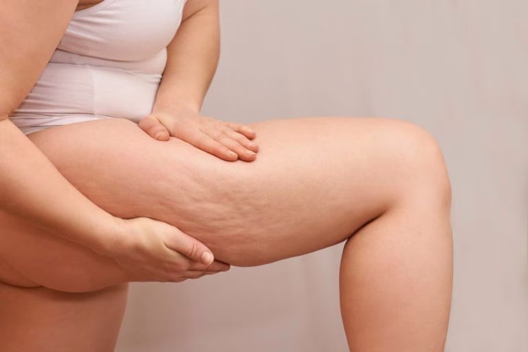 como-eliminar-la-celulitis