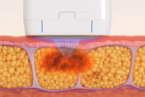 Tratamiento de tejido adiposo con enfriamiento